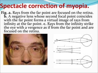 Ophthalmology 5th year, 4th lecture (Dr. Tara) | PPT