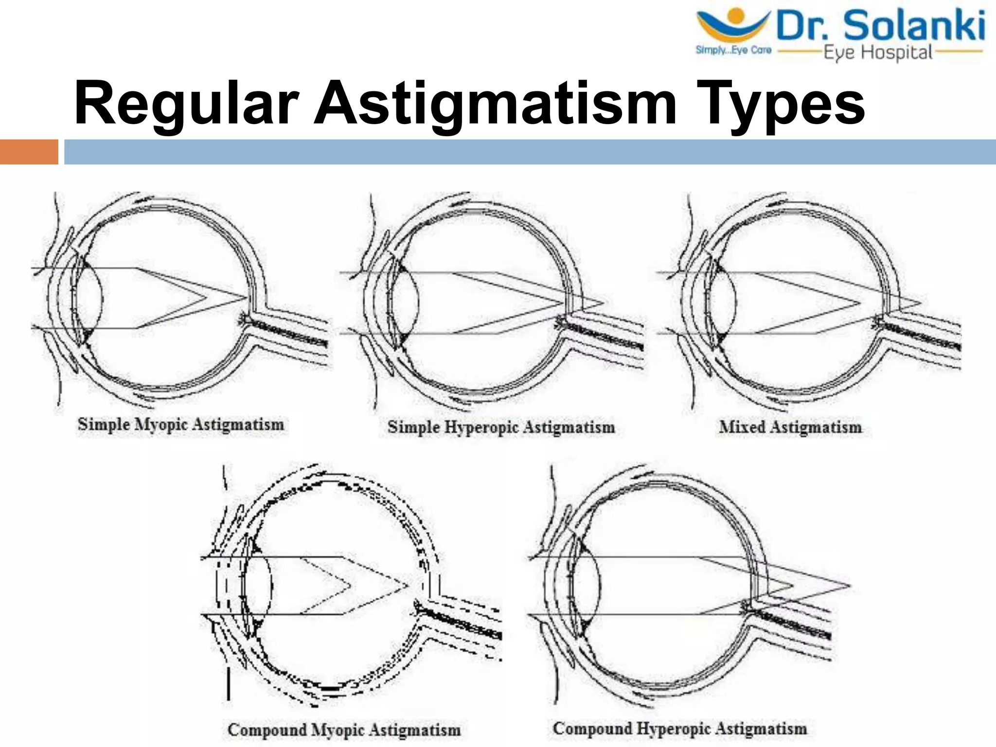 Refractive errors and how to correct them | PPTX
