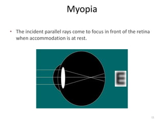 Myopia
• The incident parallel rays come to focus in front of the retina
when accommodation is at rest.
11
 