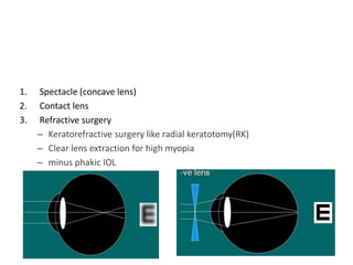 Treatmentt
1. Spectacle (concave lens)
2. Contact lens
3. Refractive surgery
– Keratorefractive surgery like radial keratotomy(RK)
– Clear lens extraction for high myopia
– minus phakic IOL
– Excimer laser surgery
13
 