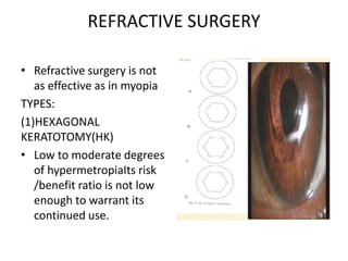 REFRACTIVE SURGERY
• Refractive surgery is not
as effective as in myopia
TYPES:
(1)HEXAGONAL
KERATOTOMY(HK)
• Low to moderate degrees
of hypermetropiaIts risk
/benefit ratio is not low
enough to warrant its
continued use.
 