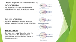 Regular Astigmatism can furter be classified as ;
SIMPLE ASTIGMATISM
 One of the foci falls upon the retina while
the other falls infront of or behind the retina.
COMPOUND ASTIGMATISM
 Neither of the foci fall upon the retina but
both are placed in front of or behind the retina.
MIXED ASTIGMATISM
 One focus is in front of the retina while the
other is behind so that the refraction is
hypermetropic in one direction & myopic in
the other direction.
 