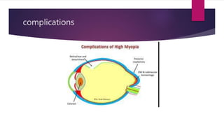 Refractive errors of eye ophthalmology astigmatism hypermetropia myopia medicine 