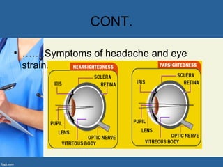 CONT.
• …….Symptoms of headache and eye
strain.
 