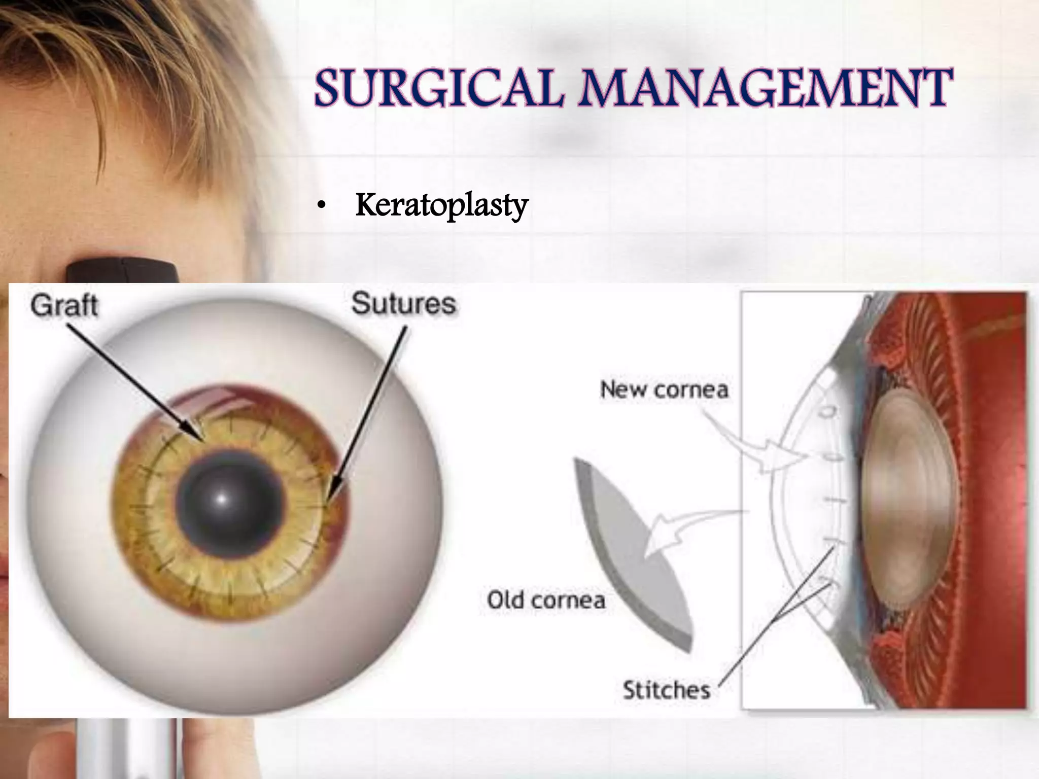 • Keratoplasty
 