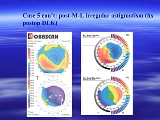 Case 5 con’t: post-M-L irregular astigmatism (hx
postop DLK)
 