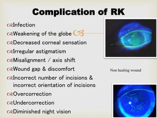 Refractive surgeries.pptx arjun | PPTX