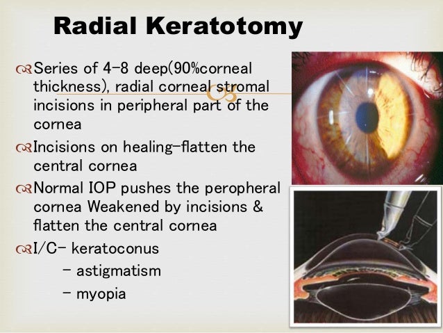 Refractive surgeries.pptx arjun wound healing diagram 