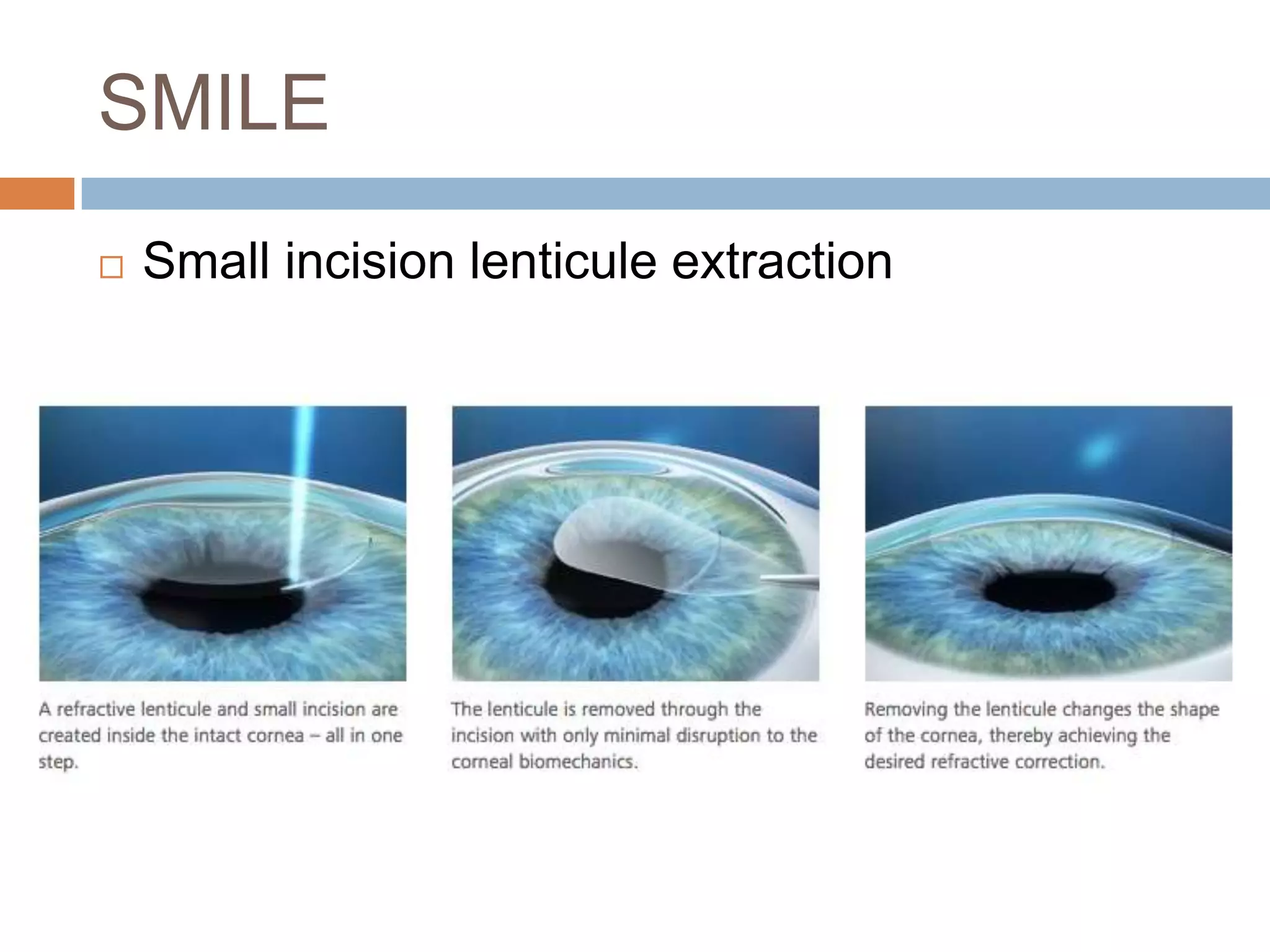 SMILE
 Small incision lenticule extraction
 