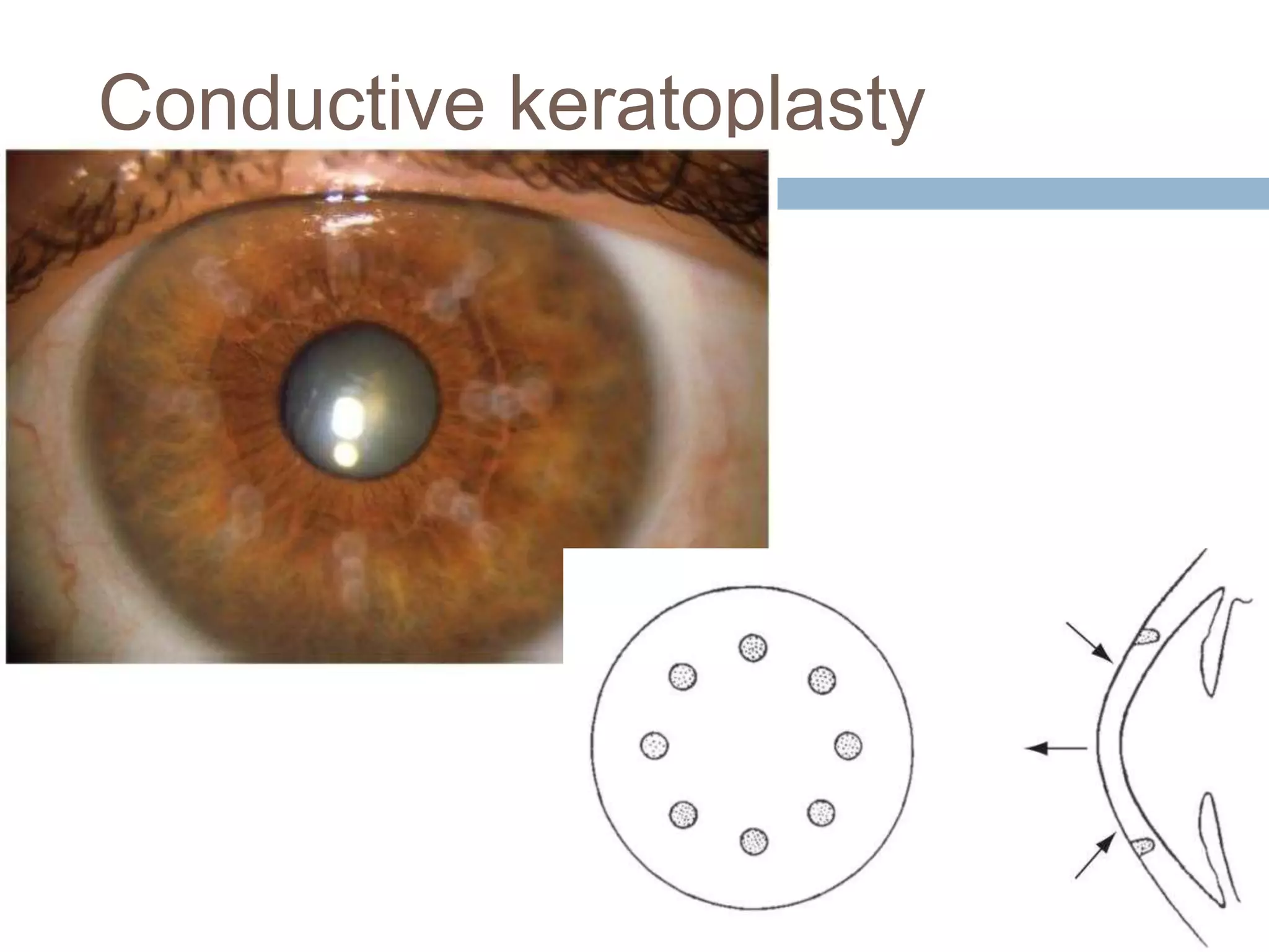 Conductive keratoplasty
 