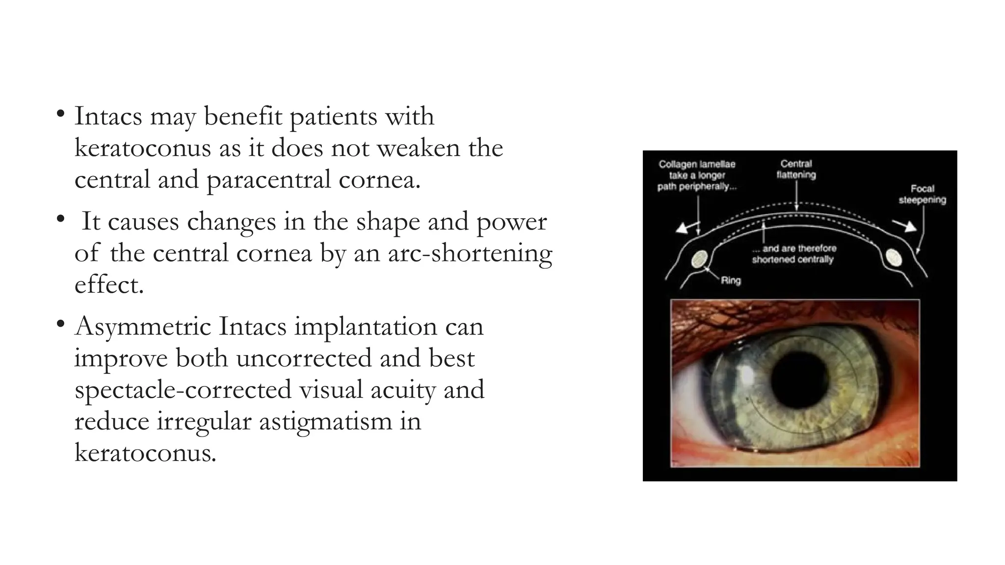 • Intacs may benefit patients with
keratoconus as it does not weaken the
central and paracentral cornea.
• It causes changes in the shape and power
of the central cornea by an arc-shortening
effect.
• Asymmetric Intacs implantation can
improve both uncorrected and best
spectacle-corrected visual acuity and
reduce irregular astigmatism in
keratoconus.
 