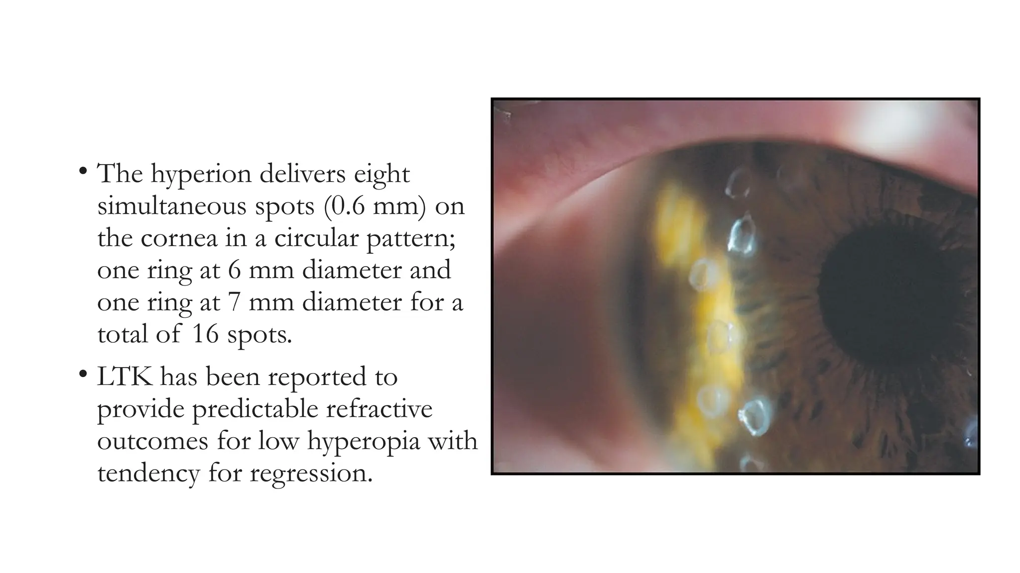 • The hyperion delivers eight
simultaneous spots (0.6 mm) on
the cornea in a circular pattern;
one ring at 6 mm diameter and
one ring at 7 mm diameter for a
total of 16 spots.
• LTK has been reported to
provide predictable refractive
outcomes for low hyperopia with
tendency for regression.
 