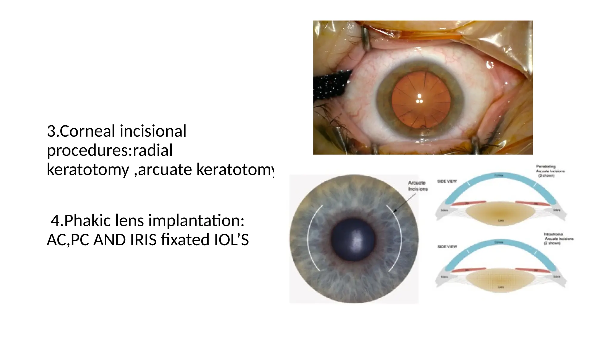 3.Corneal incisional
procedures:radial
keratotomy ,arcuate keratotomy
4.Phakic lens implantation:
AC,PC AND IRIS fixated IOL’S
 