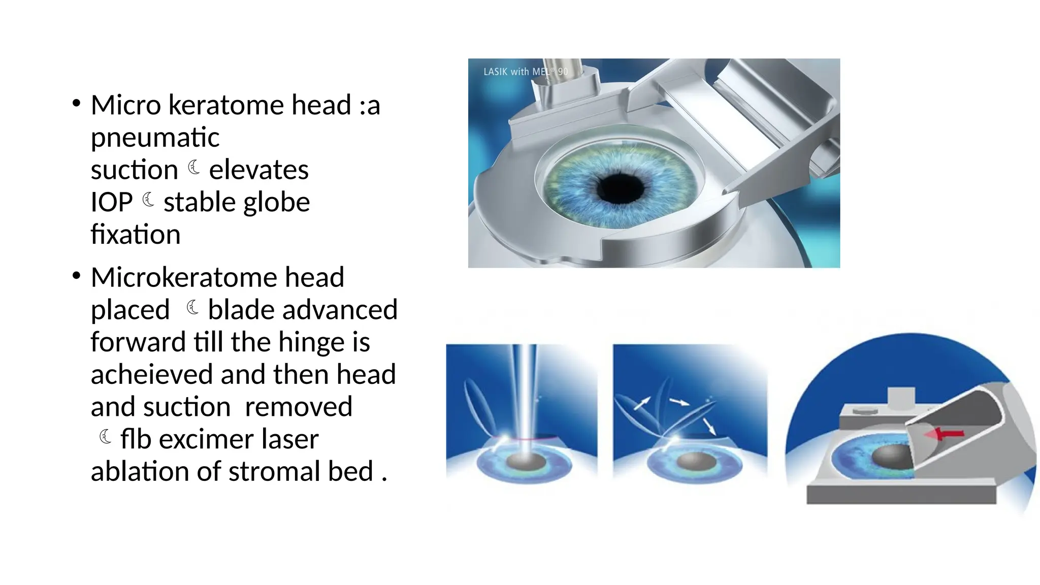 • Micro keratome head :a
pneumatic
suctionelevates
IOPstable globe
fixation
• Microkeratome head
placed blade advanced
forward till the hinge is
acheieved and then head
and suction removed
flb excimer laser
ablation of stromal bed .
 