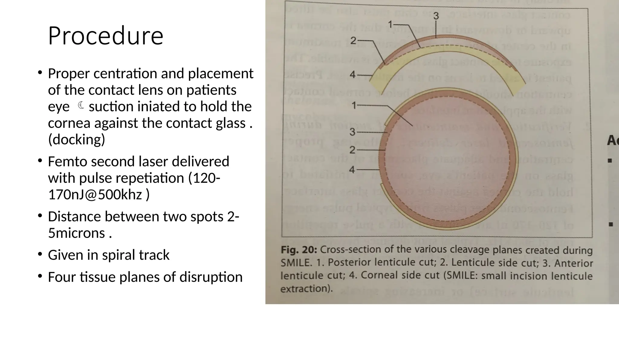 Procedure
• Proper centration and placement
of the contact lens on patients
eye suction iniated to hold the
cornea against the contact glass .
(docking)
• Femto second laser delivered
with pulse repetiation (120-
170nJ@500khz )
• Distance between two spots 2-
5microns .
• Given in spiral track
• Four tissue planes of disruption
 