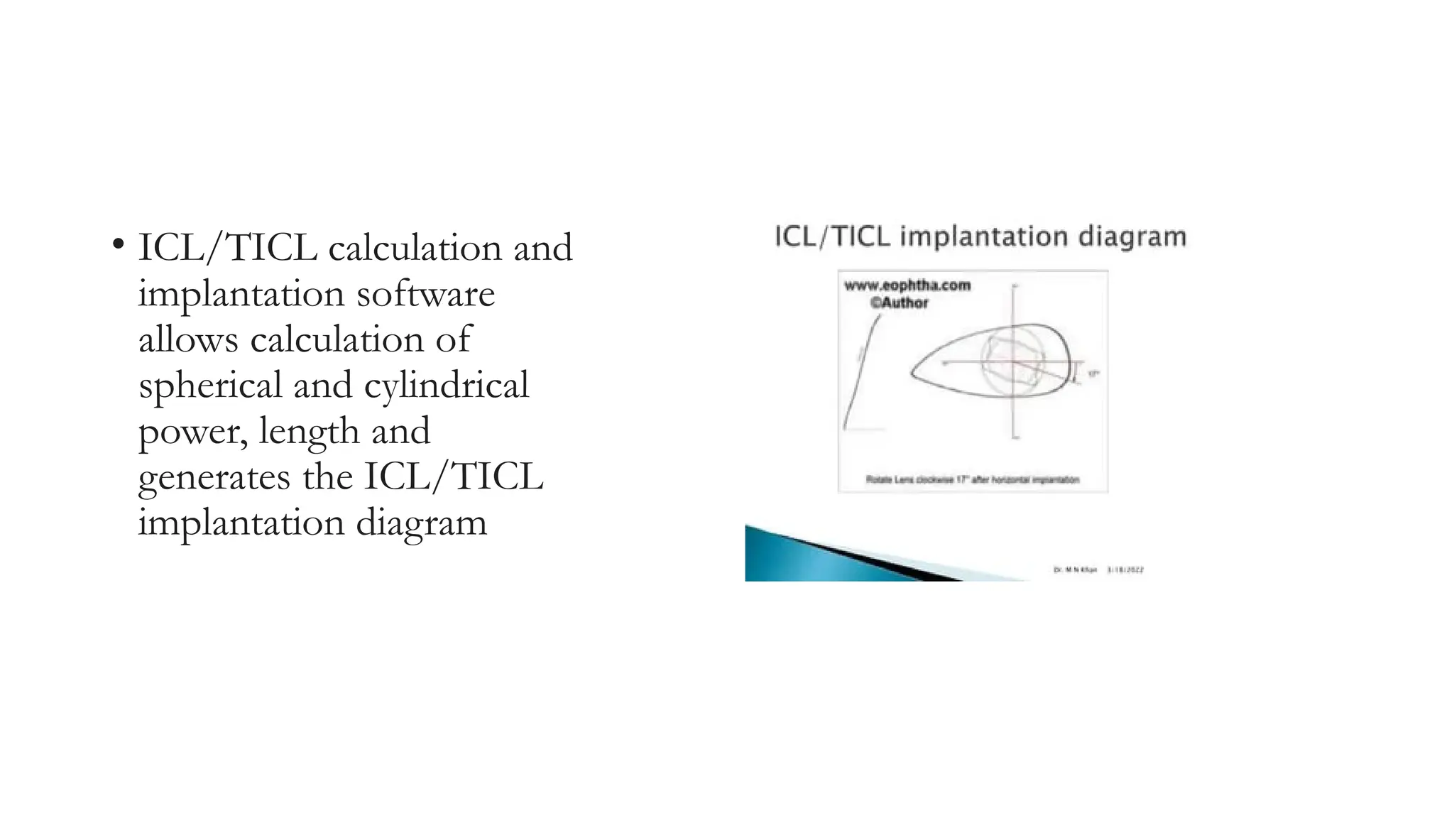 • ICL/TICL calculation and
implantation software
allows calculation of
spherical and cylindrical
power, length and
generates the ICL/TICL
implantation diagram
 