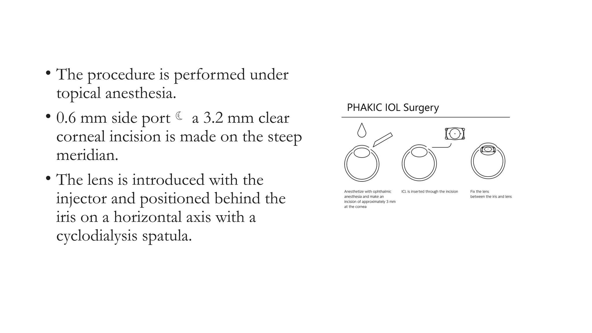 • The procedure is performed under
topical anesthesia.
• 0.6 mm side port a 3.2 mm clear
corneal incision is made on the steep
meridian.
• The lens is introduced with the
injector and positioned behind the
iris on a horizontal axis with a
cyclodialysis spatula.
 