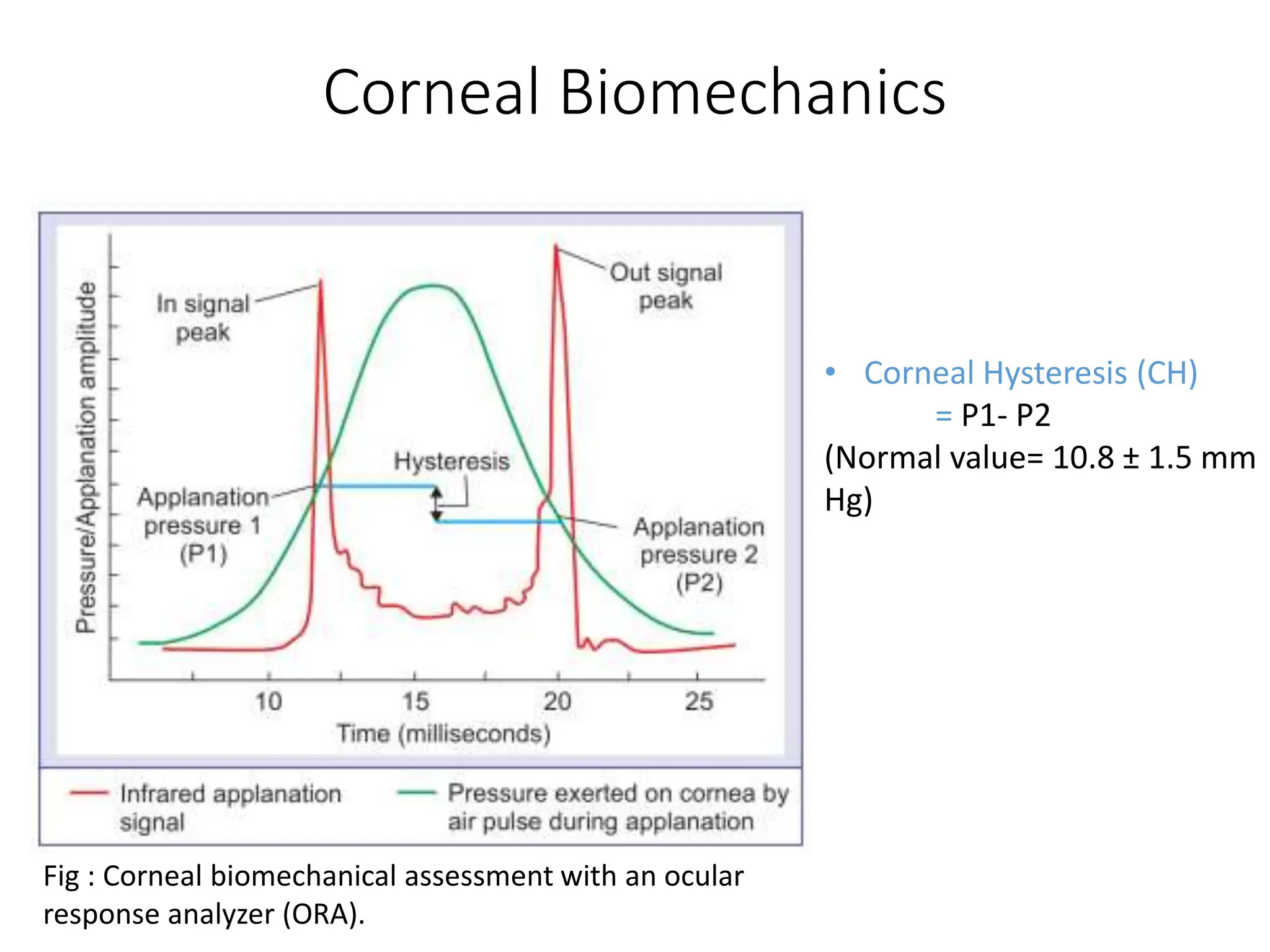 Corneal Biomechanics
Fig : Corneal biomechanical assessment with an ocular
response analyzer (ORA).
• Corneal Hysteresis (CH)
= P1- P2
(Normal value= 10.8 ± 1.5 mm
Hg)
 