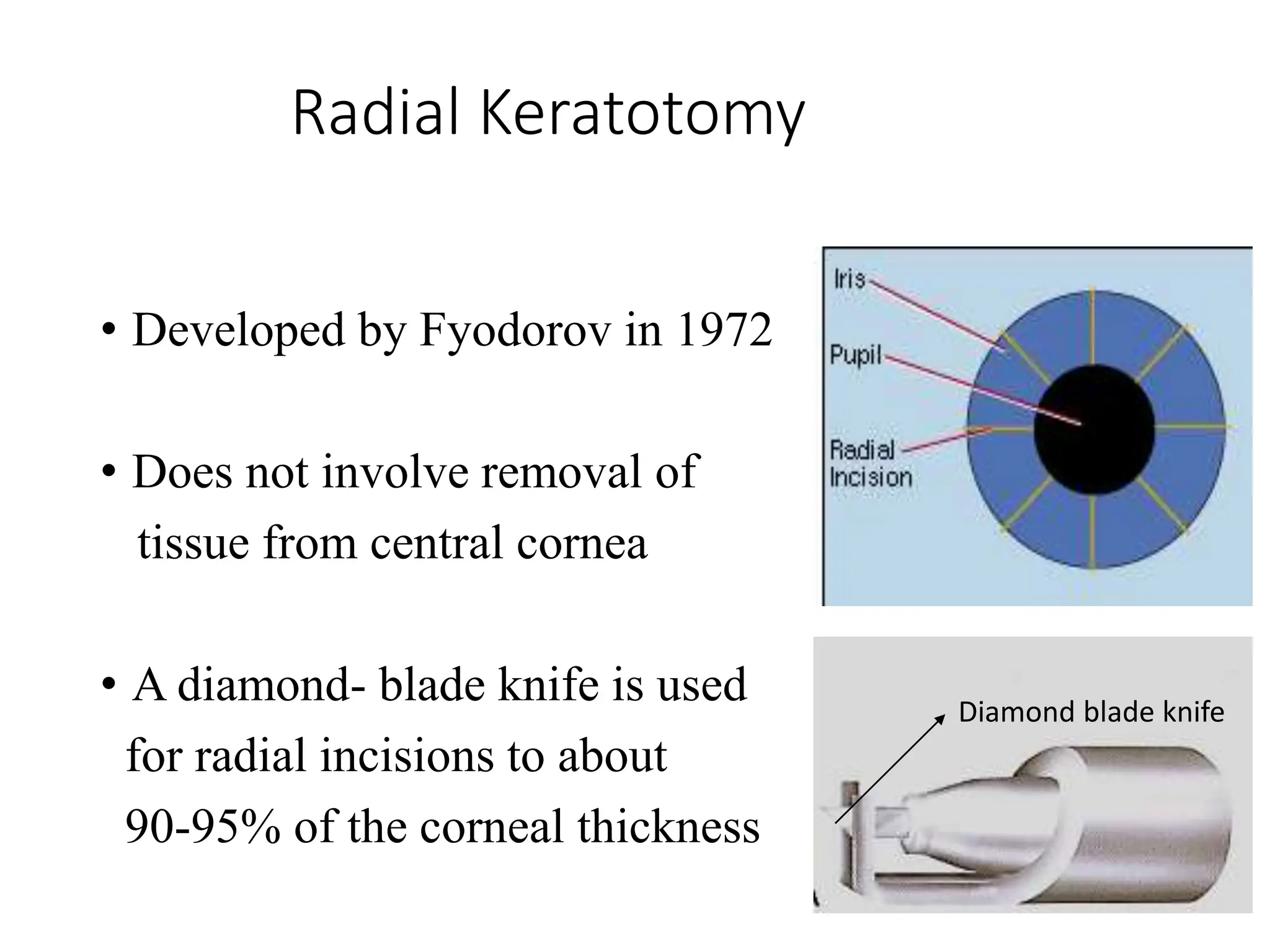 Radial Keratotomy
• Developed by Fyodorov in 1972
• Does not involve removal of
tissue from central cornea
• A diamond- blade knife is used
for radial incisions to about
90-95% of the corneal thickness
Diamond blade knife
 