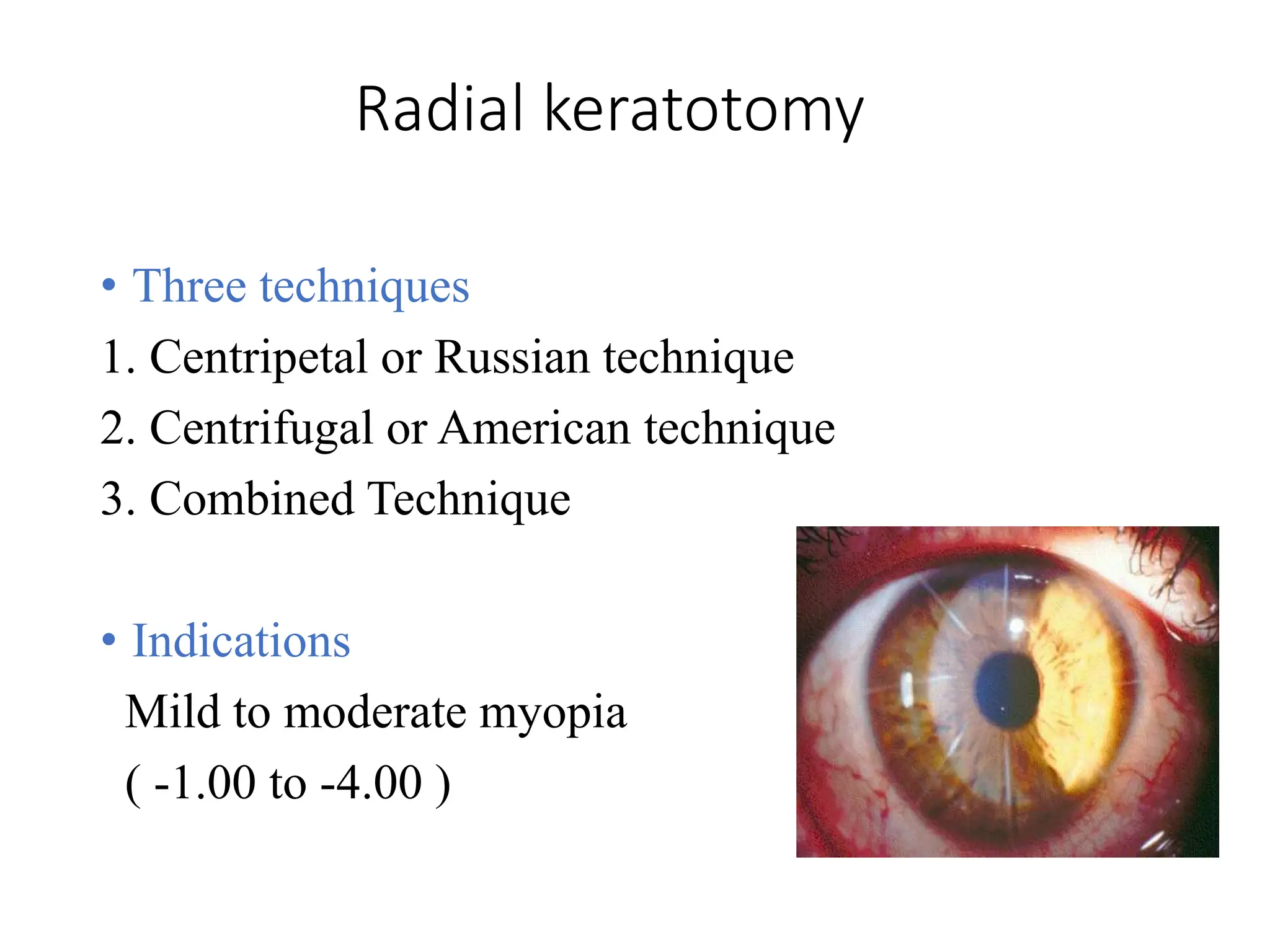 Radial keratotomy
• Three techniques
1. Centripetal or Russian technique
2. Centrifugal or American technique
3. Combined Technique
• Indications
Mild to moderate myopia
( -1.00 to -4.00 )
 