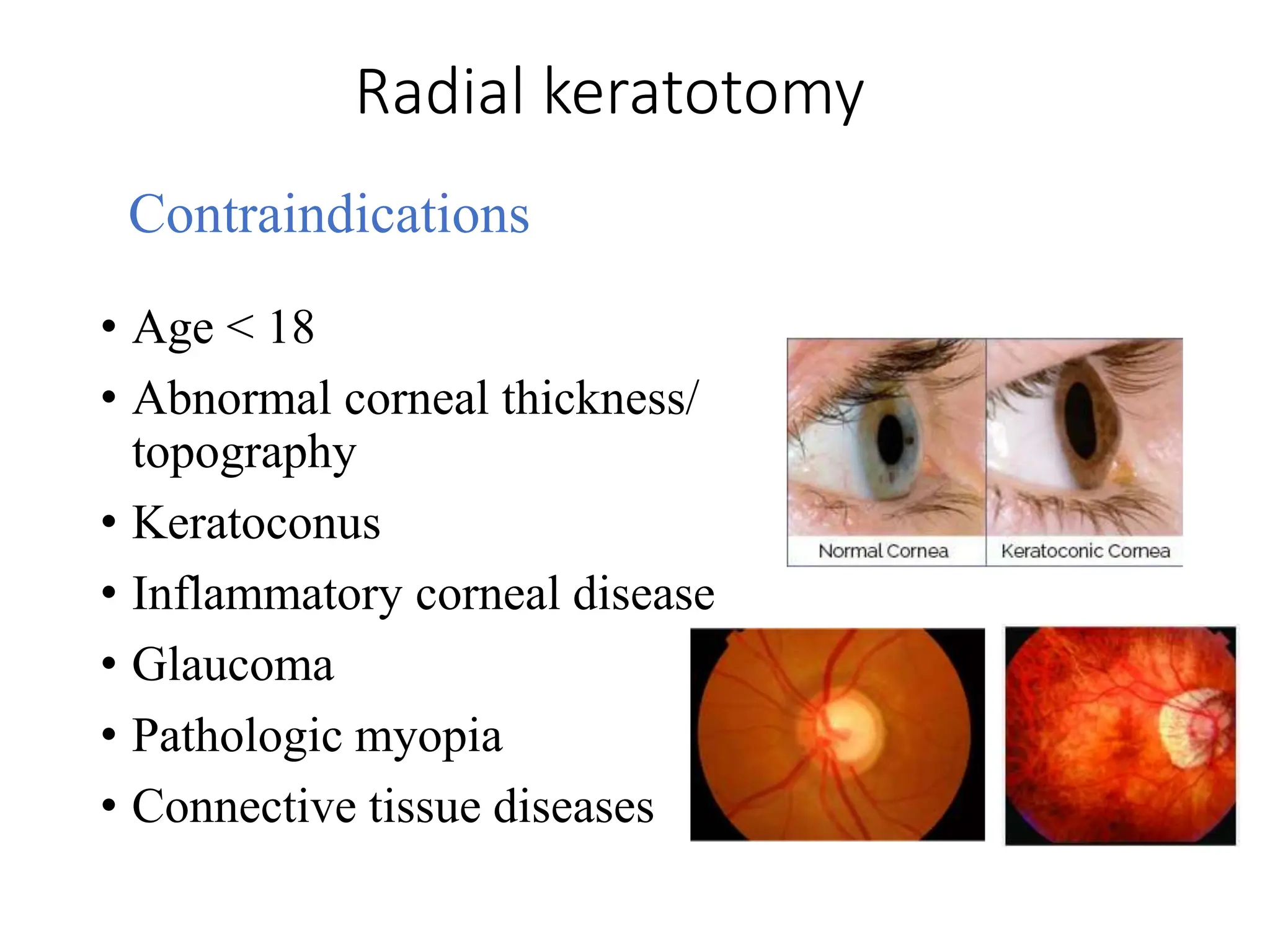 Radial keratotomy
Contraindications
• Age < 18
• Abnormal corneal thickness/
topography
• Keratoconus
• Inflammatory corneal disease
• Glaucoma
• Pathologic myopia
• Connective tissue diseases
 