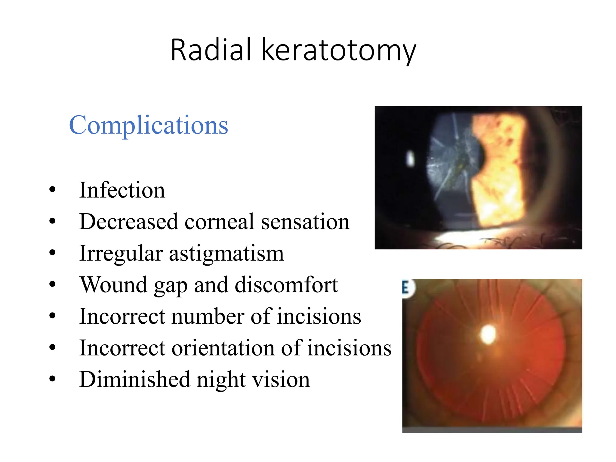 Complications
• Infection
• Decreased corneal sensation
• Irregular astigmatism
• Wound gap and discomfort
• Incorrect number of incisions
• Incorrect orientation of incisions
• Diminished night vision
Radial keratotomy
 
