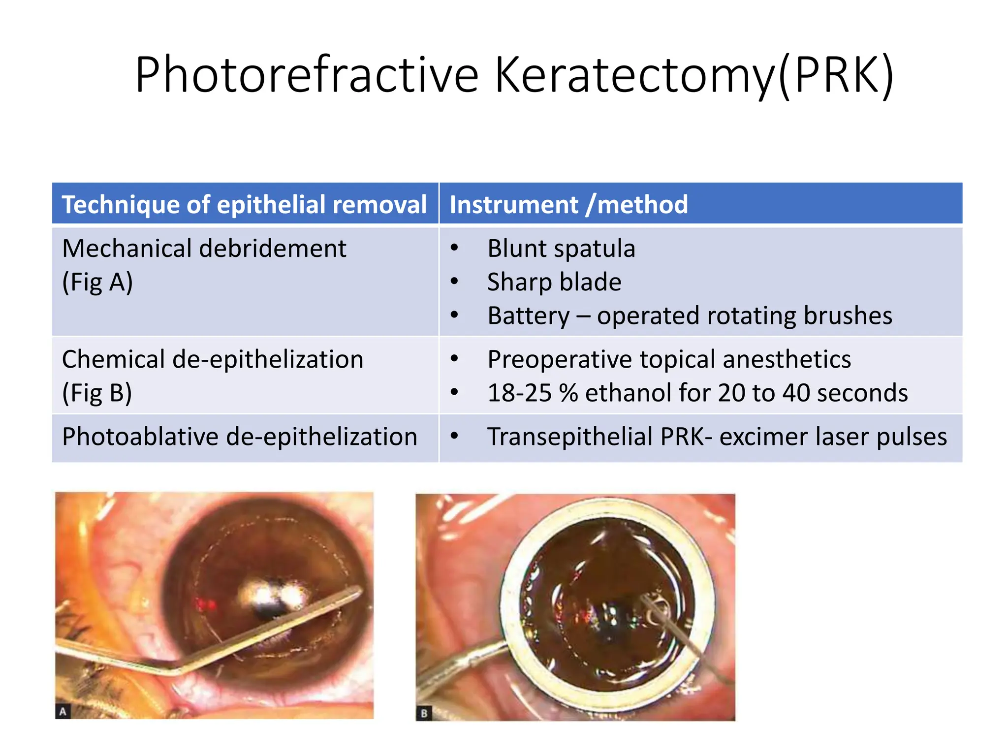 Photorefractive Keratectomy(PRK)
Technique of epithelial removal Instrument /method
Mechanical debridement
(Fig A)
• Blunt spatula
• Sharp blade
• Battery – operated rotating brushes
Chemical de-epithelization
(Fig B)
• Preoperative topical anesthetics
• 18-25 % ethanol for 20 to 40 seconds
Photoablative de-epithelization • Transepithelial PRK- excimer laser pulses
 