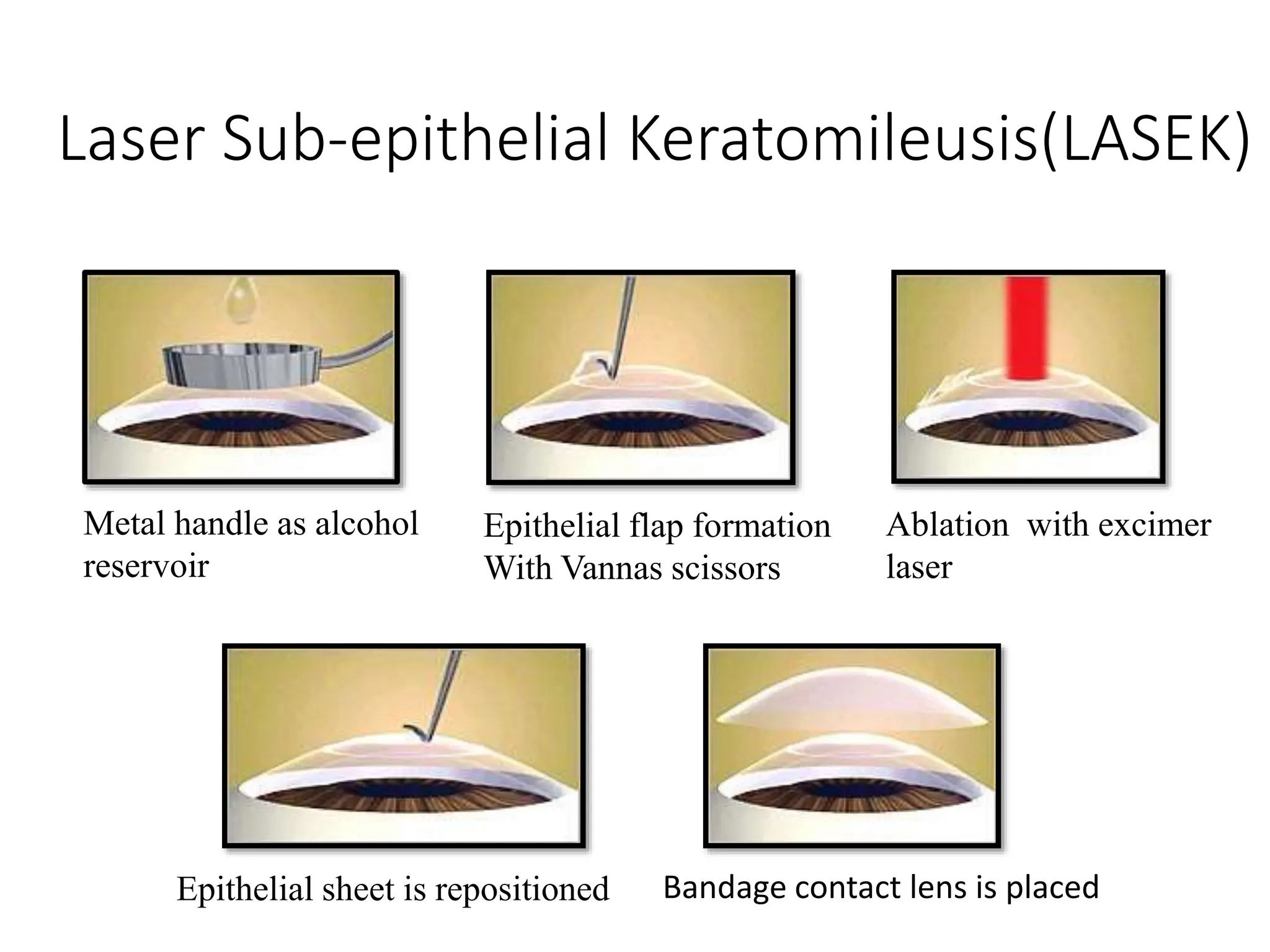Laser Sub-epithelial Keratomileusis(LASEK)
Metal handle as alcohol
reservoir
Epithelial flap formation
With Vannas scissors
Ablation with excimer
laser
Epithelial sheet is repositioned Bandage contact lens is placed
 