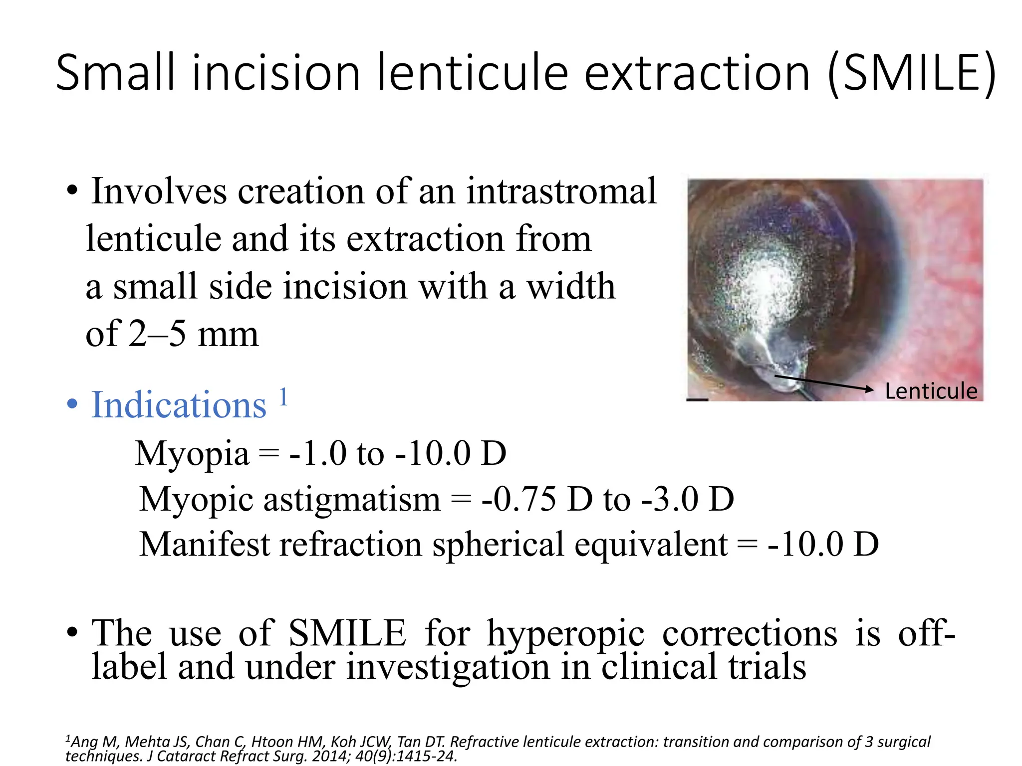 Small incision lenticule extraction (SMILE)
• Involves creation of an intrastromal
lenticule and its extraction from
a small side incision with a width
of 2–5 mm
• Indications 1
Myopia = -1.0 to -10.0 D
Myopic astigmatism = -0.75 D to -3.0 D
Manifest refraction spherical equivalent = -10.0 D
• The use of SMILE for hyperopic corrections is off-
label and under investigation in clinical trials
1Ang M, Mehta JS, Chan C, Htoon HM, Koh JCW, Tan DT. Refractive lenticule extraction: transition and comparison of 3 surgical
techniques. J Cataract Refract Surg. 2014; 40(9):1415-24.
Lenticule
 