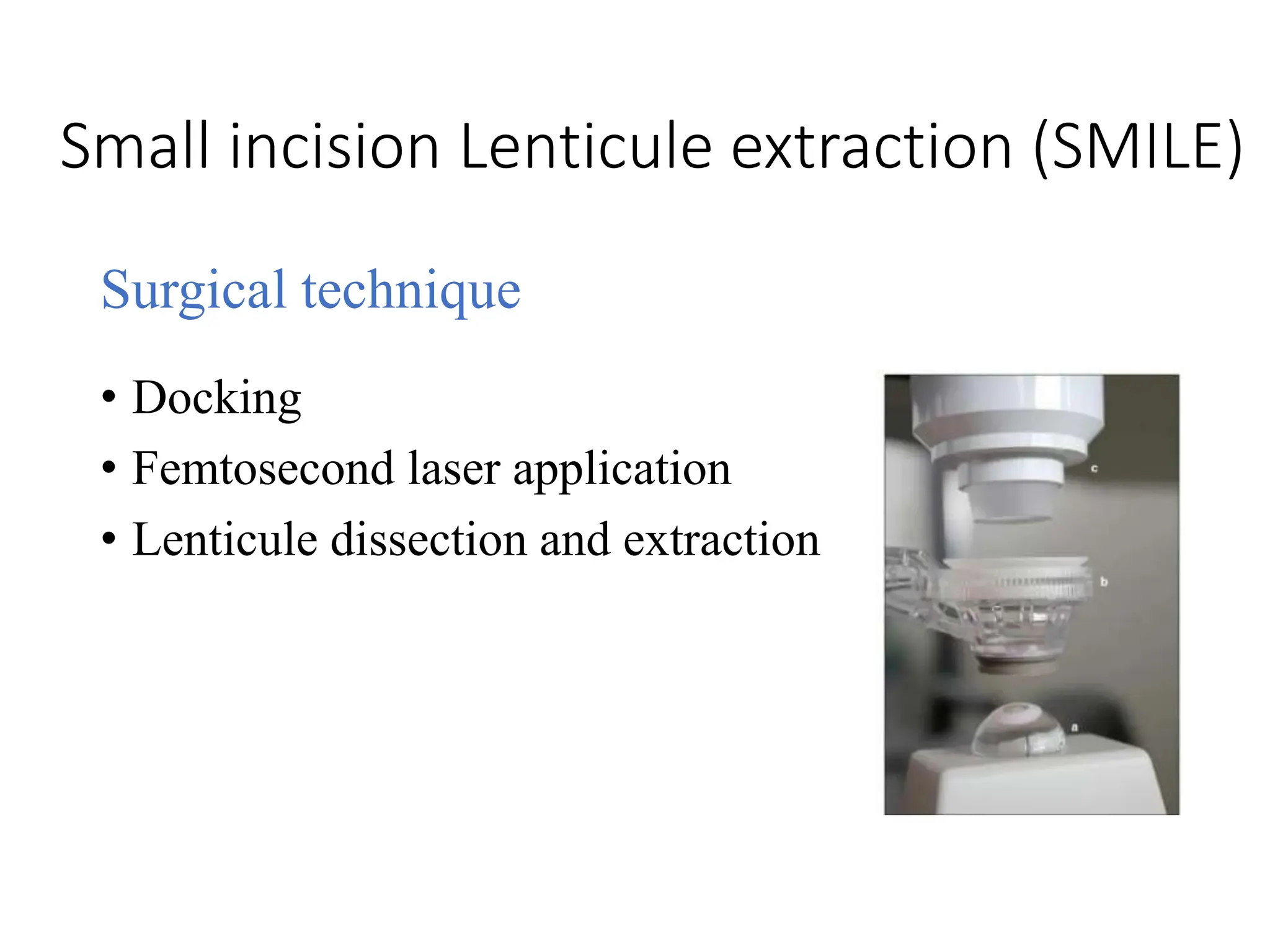 Small incision Lenticule extraction (SMILE)
Surgical technique
• Docking
• Femtosecond laser application
• Lenticule dissection and extraction
 