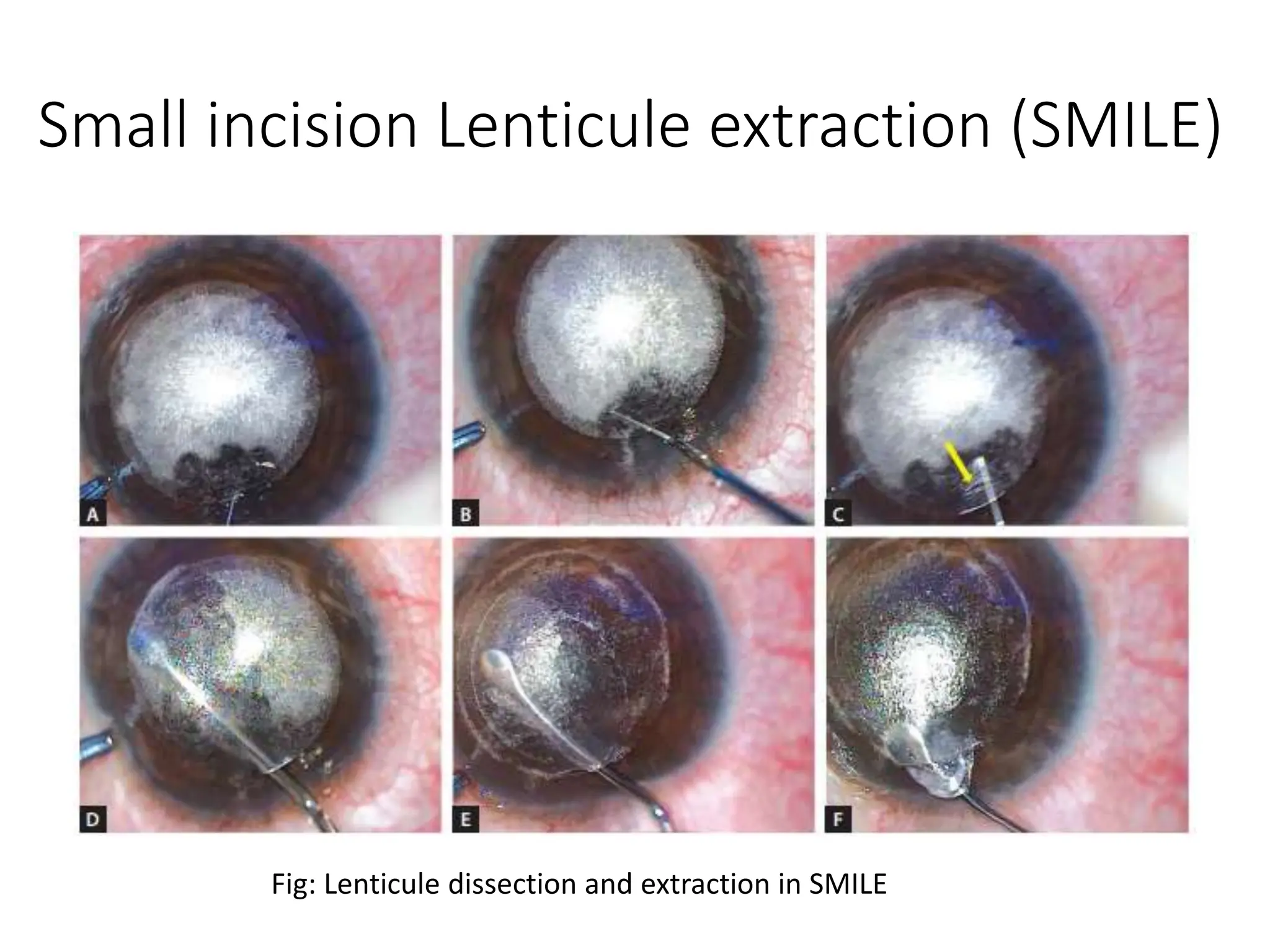 Small incision Lenticule extraction (SMILE)
Fig: Lenticule dissection and extraction in SMILE
 