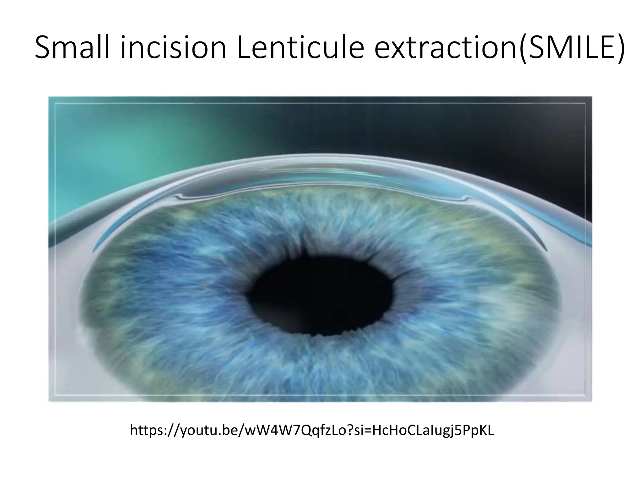 Small incision Lenticule extraction(SMILE)
https://youtu.be/wW4W7QqfzLo?si=HcHoCLaIugj5PpKL
 