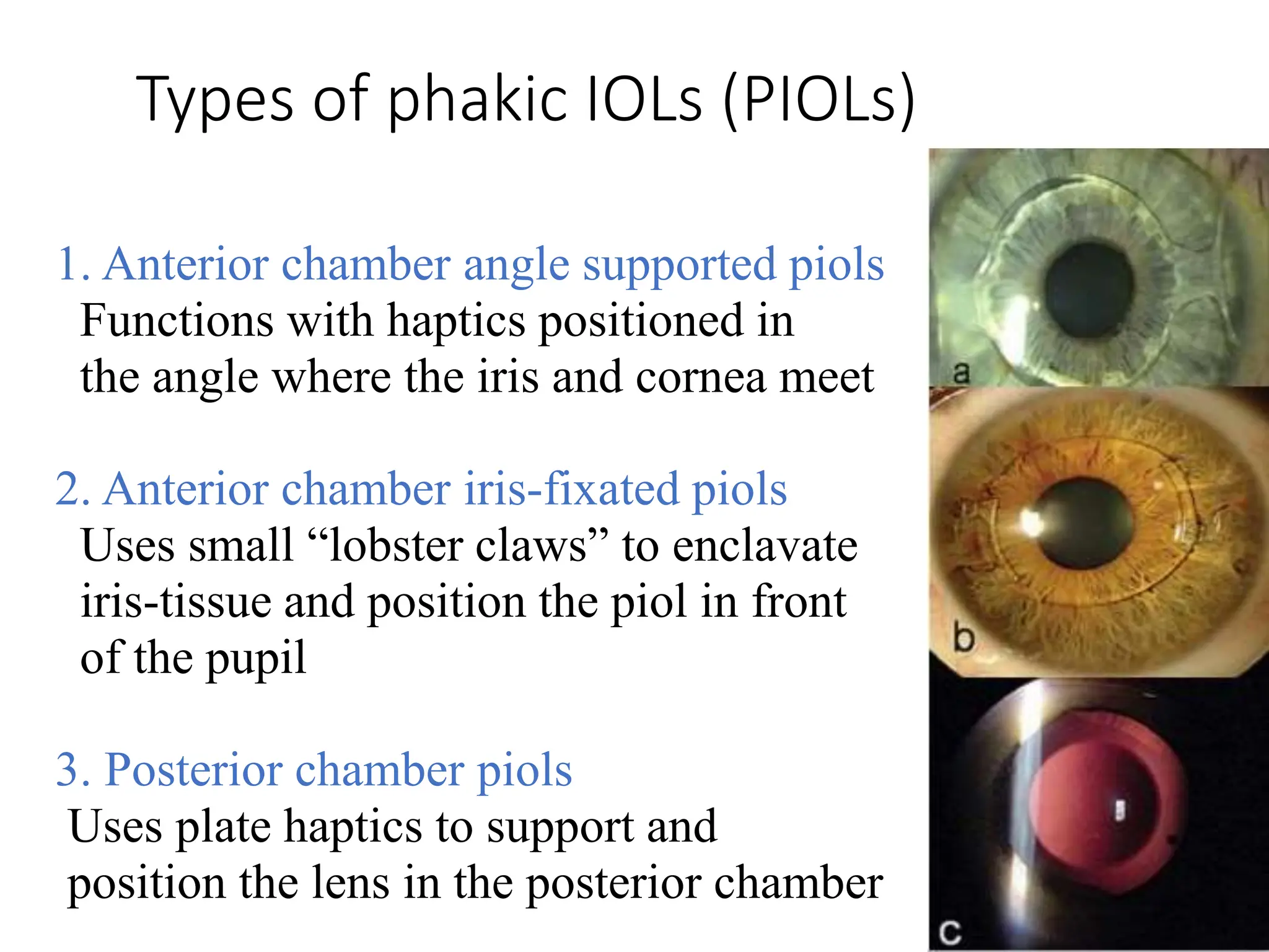 Types of phakic IOLs (PIOLs)
1. Anterior chamber angle supported piols
Functions with haptics positioned in
the angle where the iris and cornea meet
2. Anterior chamber iris-fixated piols
Uses small “lobster claws” to enclavate
iris-tissue and position the piol in front
of the pupil
3. Posterior chamber piols
Uses plate haptics to support and
position the lens in the posterior chamber
 