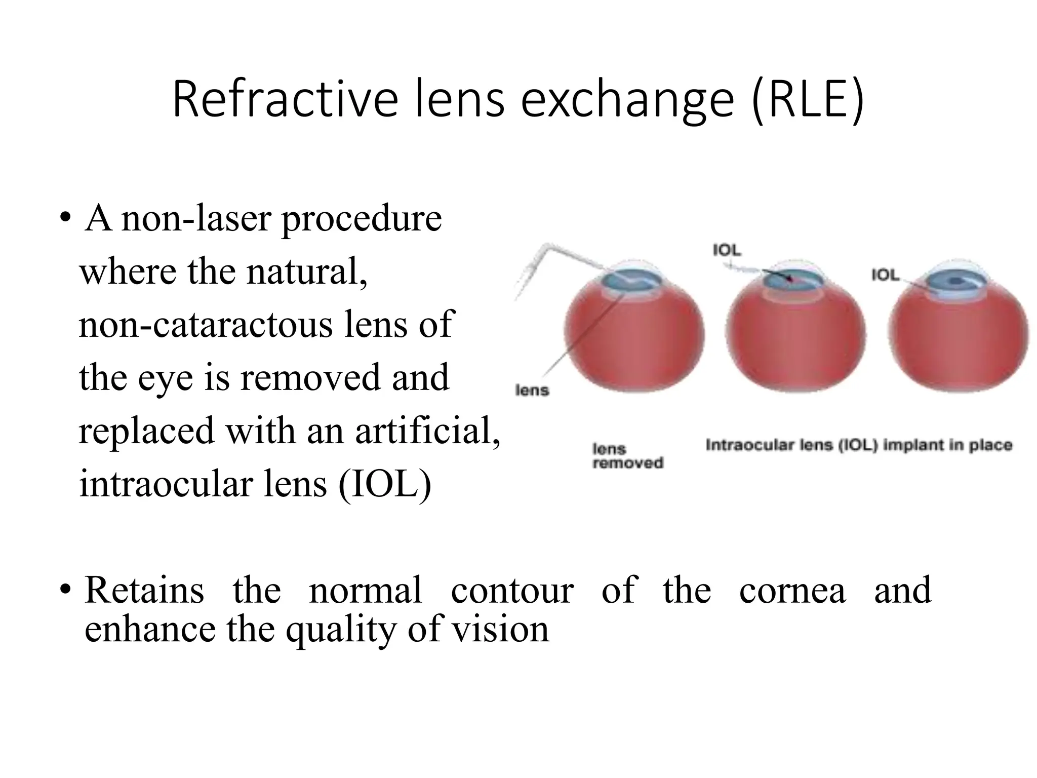 Refractive lens exchange (RLE)
• A non-laser procedure
where the natural,
non-cataractous lens of
the eye is removed and
replaced with an artificial,
intraocular lens (IOL)
• Retains the normal contour of the cornea and
enhance the quality of vision
 