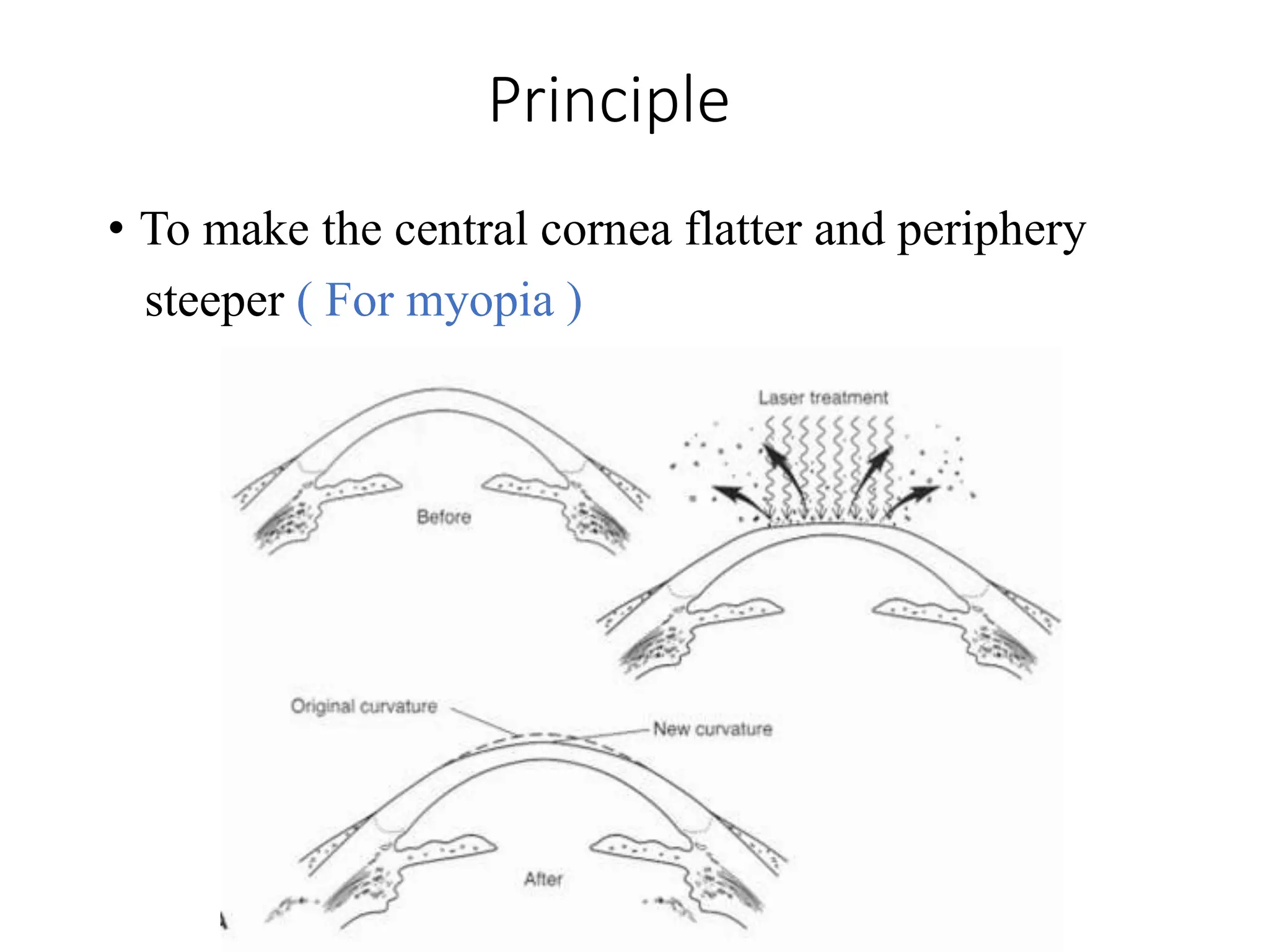 Principle
• To make the central cornea flatter and periphery
steeper ( For myopia )
 