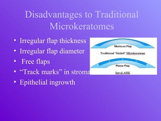 Disadvantages to Traditional
Microkeratomes
• Irregular flap thickness
• Irregular flap diameter
• Free flaps
• “Track marks” in stromal bed
• Epithelial ingrowth
 