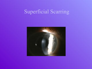Superficial Scarring
 
