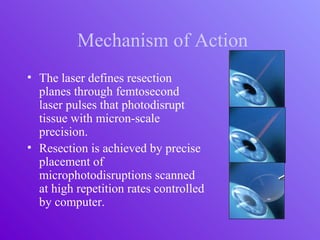 Mechanism of Action
• The laser defines resection
planes through femtosecond
laser pulses that photodisrupt
tissue with micron-scale
precision.
• Resection is achieved by precise
placement of
microphotodisruptions scanned
at high repetition rates controlled
by computer.
 