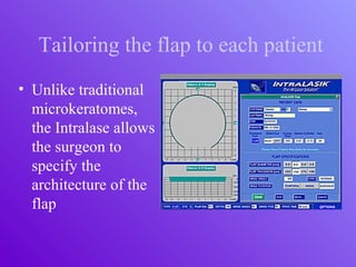Tailoring the flap to each patient
• Unlike traditional
microkeratomes,
the Intralase allows
the surgeon to
specify the
architecture of the
flap
 