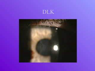 DLK
 