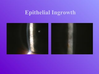 Epithelial Ingrowth
 