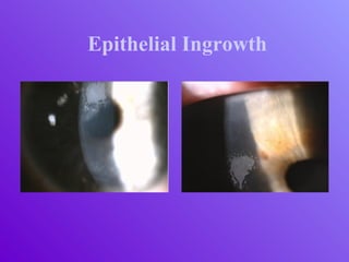 Epithelial Ingrowth
 