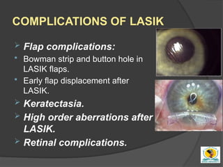 Refractive surgery for undergraduate simply | PPTX