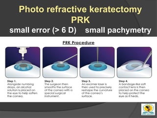 Refractive surgery for undergraduate simply | PPTX