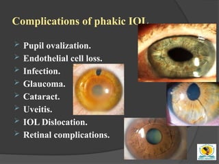 Refractive surgery for undergraduate simply | PPTX