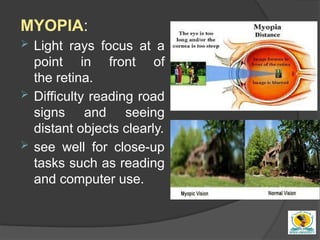 Refractive surgery for undergraduate simply | PPTX