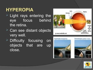 Refractive surgery for undergraduate simply | PPTX