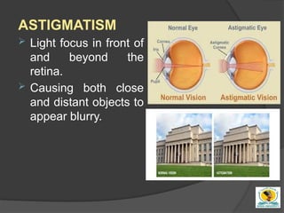 Refractive surgery for undergraduate simply | PPTX