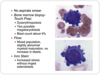  No aspirate smear
 Bone marrow biopsy-
Touch Prep:
 Dyserythropoiesis
 Two possible
megakaryoblasts
 Blast count about 4%
 Flow:
 Mixed population,
slightly abnormal
myeloid maturation, no
increase in blasts.
 Iron Stain:
 Increased stores
without ringed
sideroblasts
 