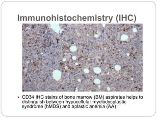 Immunohistochemistry (IHC)
 CD34 IHC stains of bone marrow (BM) aspirates helps to
distinguish between hypocellular myelodysplastic
syndrome (hMDS) and aplastic anemia (AA)
 